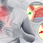 Vrací se vám potrava ze žaludku a trápí vás pálení žáhy? Pravděpodobně trpíte na reflux jícnu. Nepodceňujte jej, umí zničit i zuby.