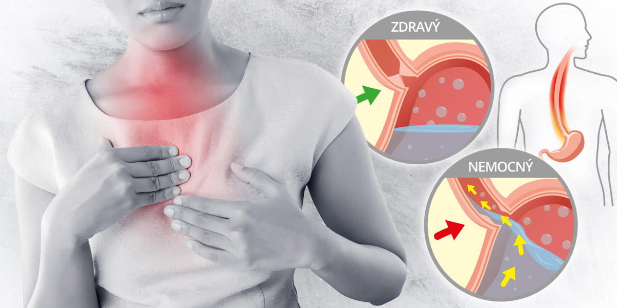 Vrací se vám potrava ze žaludku a trápí vás pálení žáhy? Pravděpodobně trpíte na reflux jícnu. Nepodceňujte jej, umí zničit i zuby.