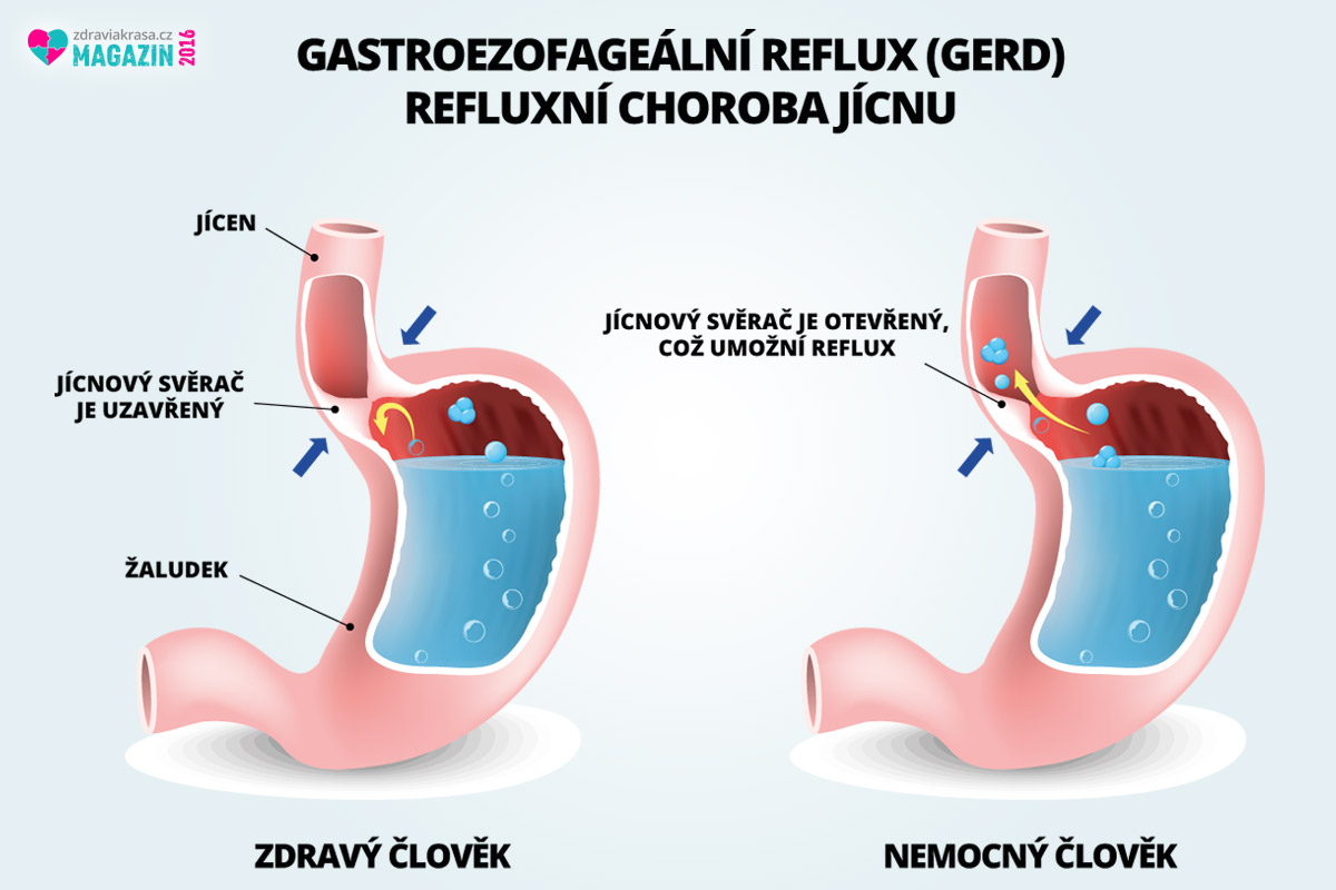 Reflux jícnu je způsobován zvýšeným tlakem, nezdravým životním stylem, cvičením po jídle, ale i stresem. Dá se úspěšně diagnostikovat i léčit.