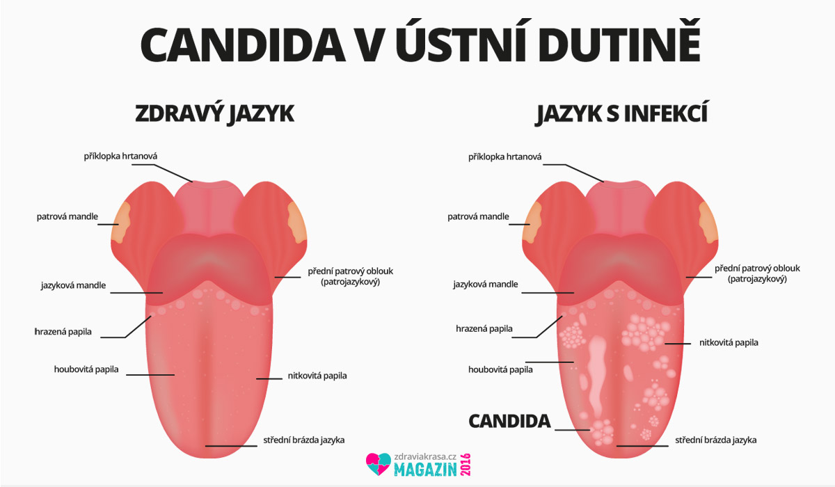 Kvasinková houba v na jazyku v ústní dutině.