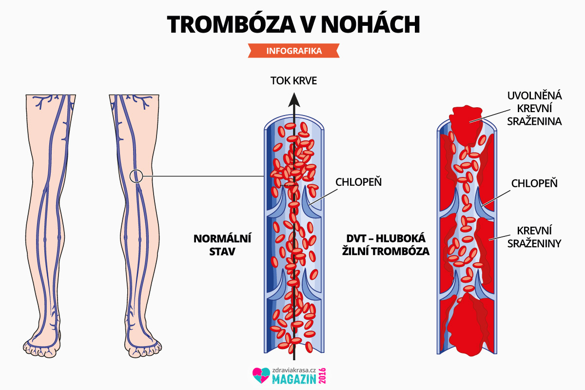 Trombóza vzniká většinou v končetinách, nejčastější v nohách.