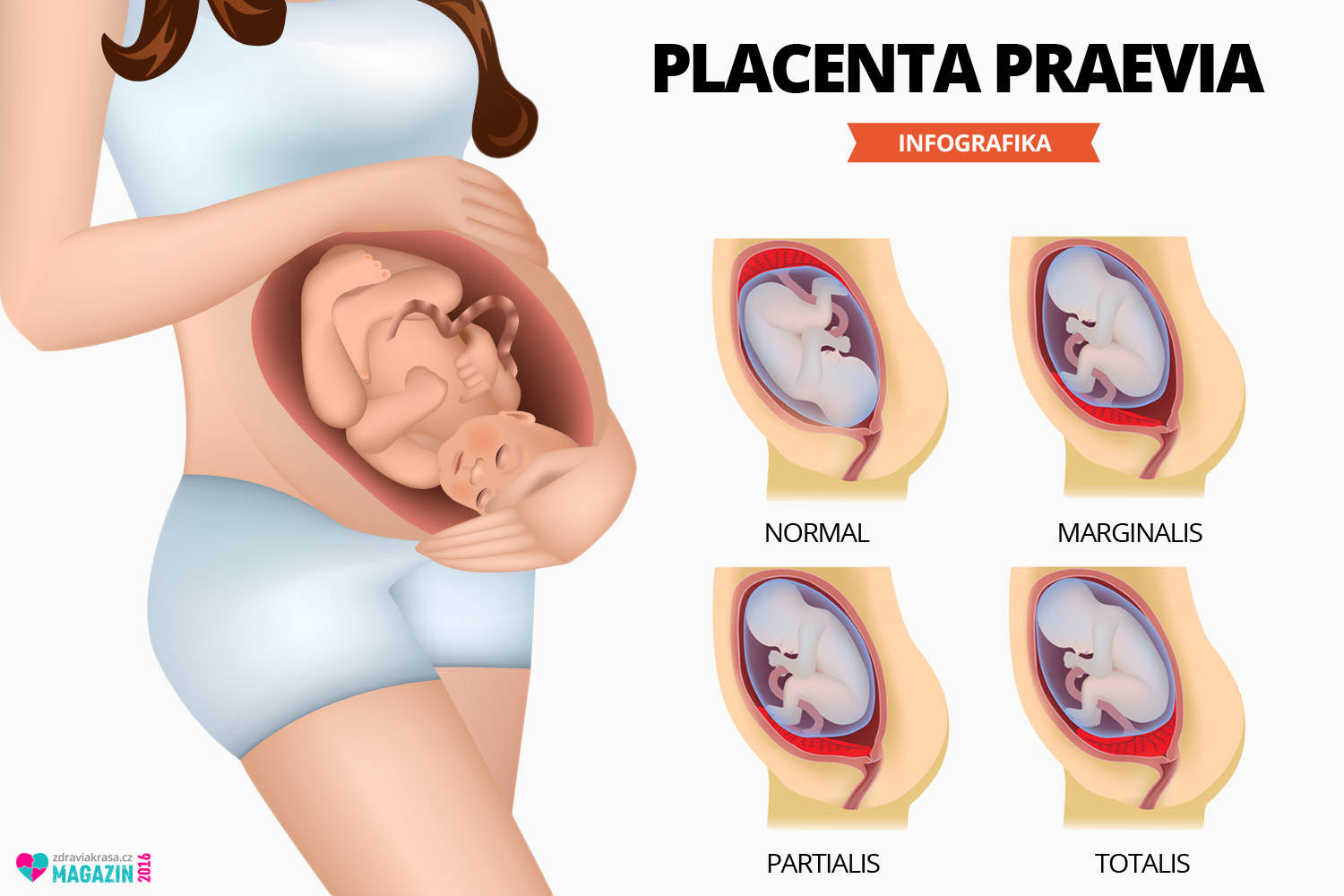 Placenta je umístěná na děložní stěně obvykle vepředu, vzadu nebo nahoře. Ke komplikaci dochází, pokud je umístěná dolu v děložním fundu (těle). V této poloze často zasahuje, nebo zcela překrývá vchod do porodních cest a brání tak standardnímu vaginálnímu porodu. Na obrázku vidíte normální umístění placenty bez komplikací.