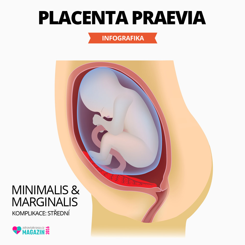 Placenta preavia v méně komplikovaném stádiu – placenta se dotýká nebo jen jen částečně překrývá vchod do porodních cest.