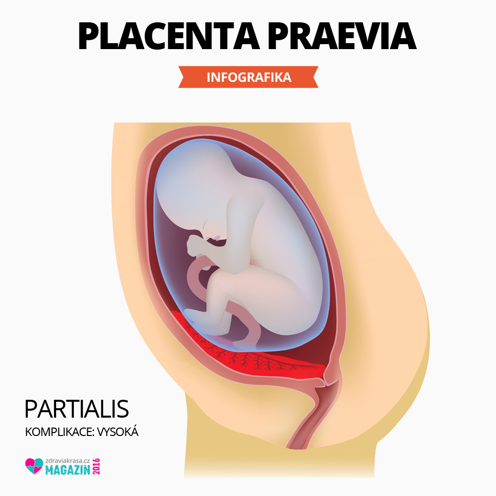 Placenta preavia ve více komplikovaném stádiu – placenta z velké části pokrývá děložní čípek, čímž z velké části překrývá vchod do porodních cest. 