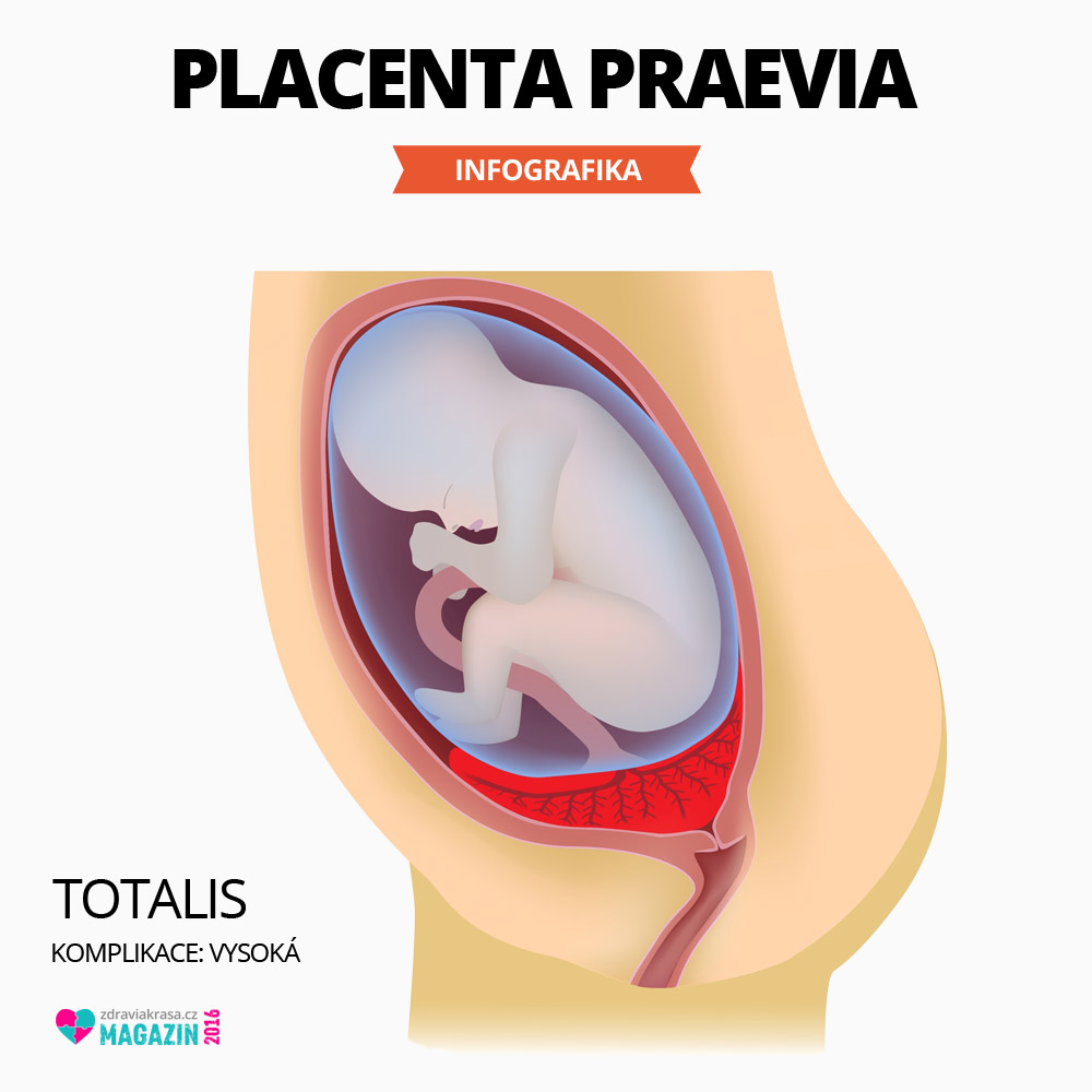 Velmi komplikovaný stav placenta preavia – v této fázi se již jednoznačně volí porod císařským řezem. V opačném případě hrozí poškození dítěte až jeho smrt a současně vykrvácení matky při porodu.