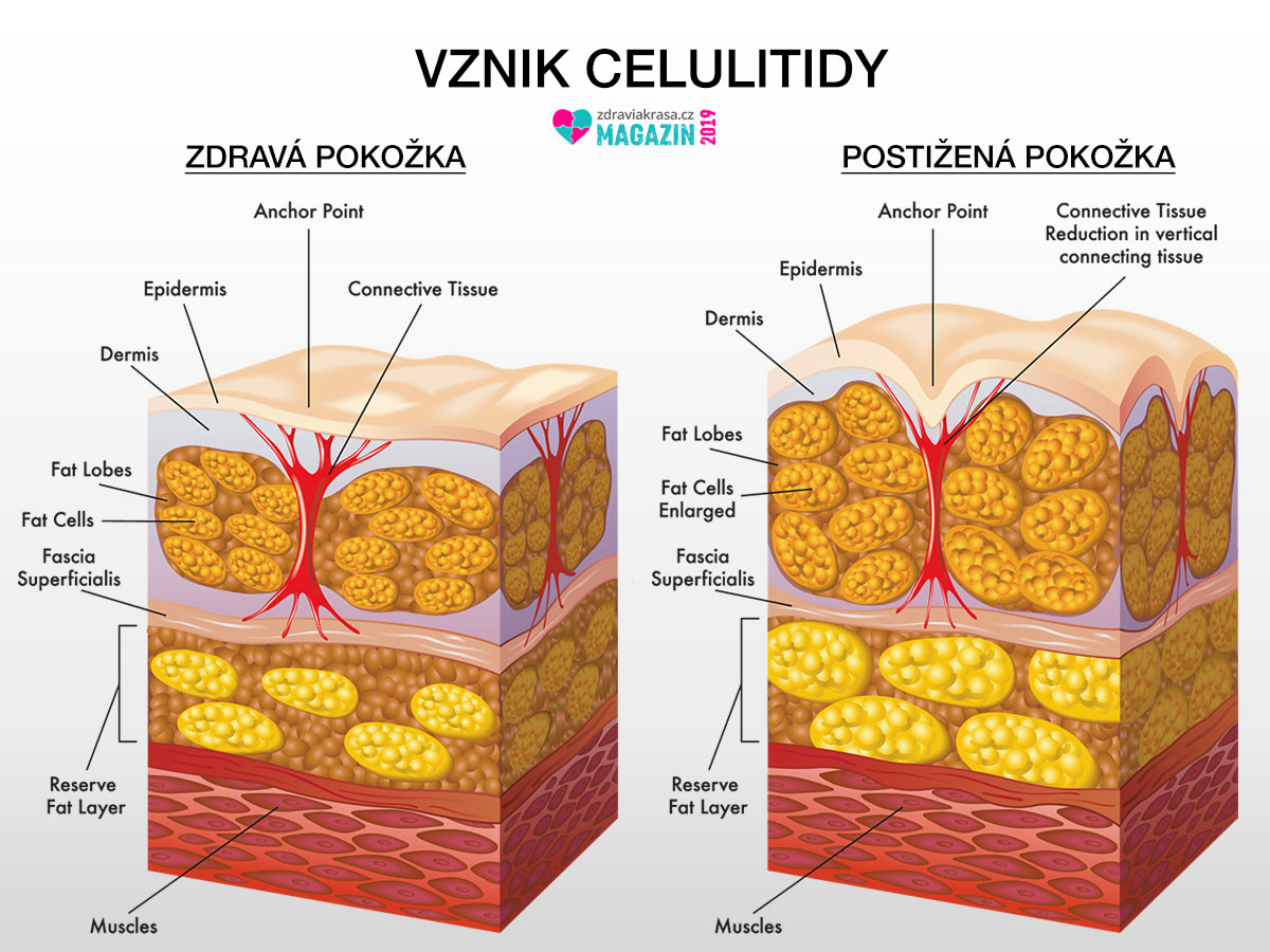 Celulitida nemusí být pouze estetickým problémem. Řada žen si stěžuje, že je pokožka kvůli celulitidě bolí.