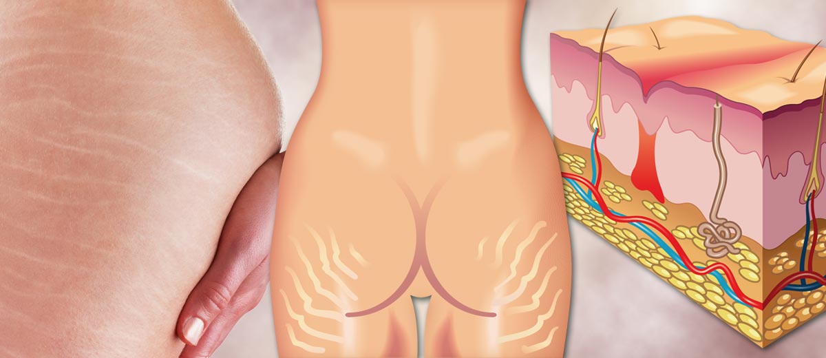 Nehezké jizvičky viditelné na kůži, nazývané strie neboli pajizévky, trápí řadu žen i mužů. Nejsou jen důsledkem těhotenství a postihnou i „dietáře“ či sportovce.